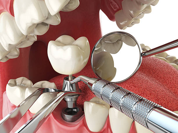 Best Emergency Treatment for Dental Infections or Abscesses in Peabody, KS